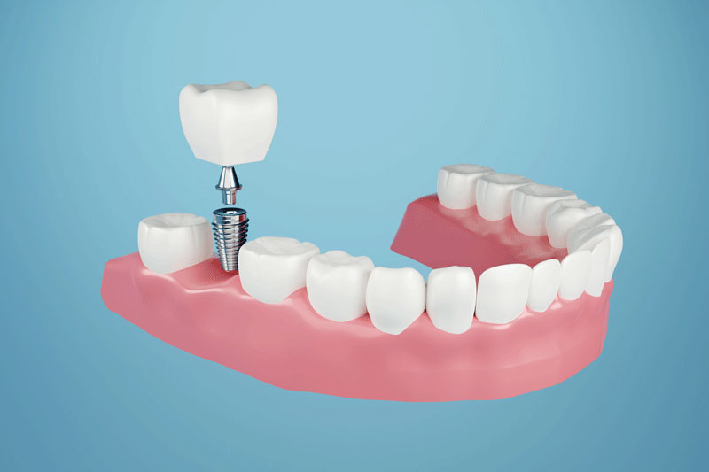 Dental Implants in Encino