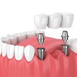 Dental Implants in Encino