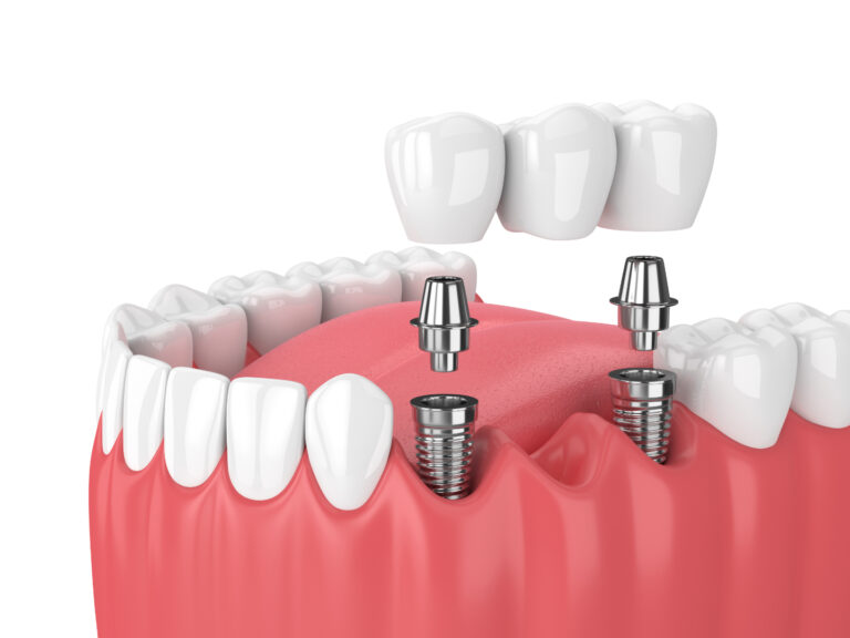 Dental Implants in Encino