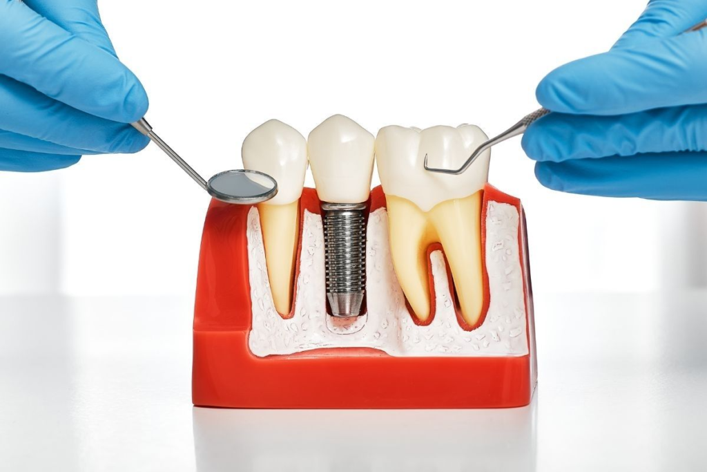 dental implants