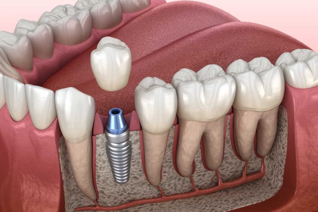 Implants Dentist in Agoura Hills