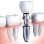 Best Implants in Agoura Hills