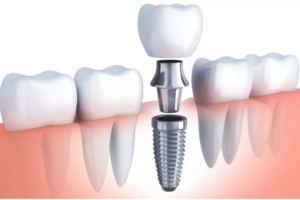 Best Implants in Agoura Hills